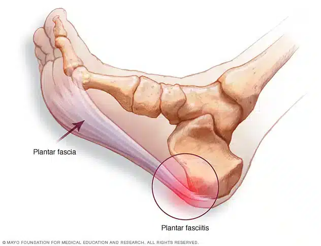 anatomical foot diagram displaying tension on the plantar fascia resulting in plantar fasciitis
